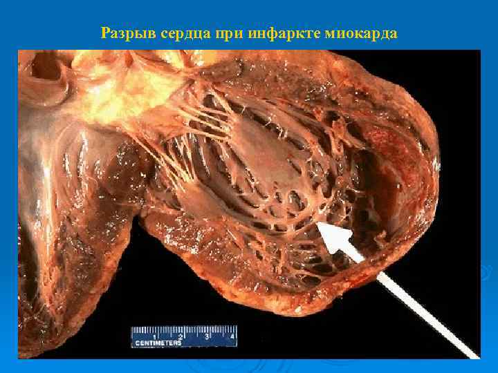 Разрыв сердца при инфаркте миокарда 