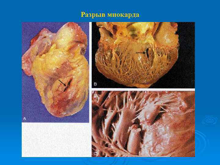 Разрыв миокарда 