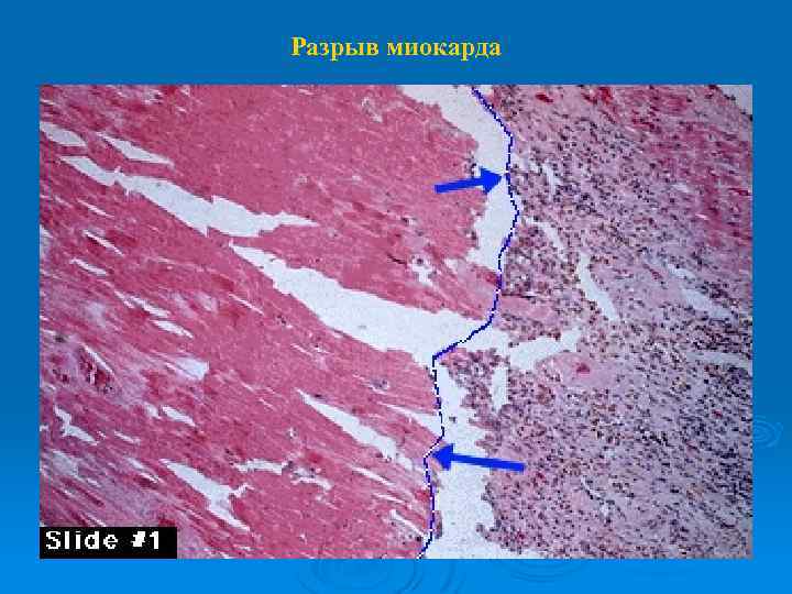 Разрыв миокарда 