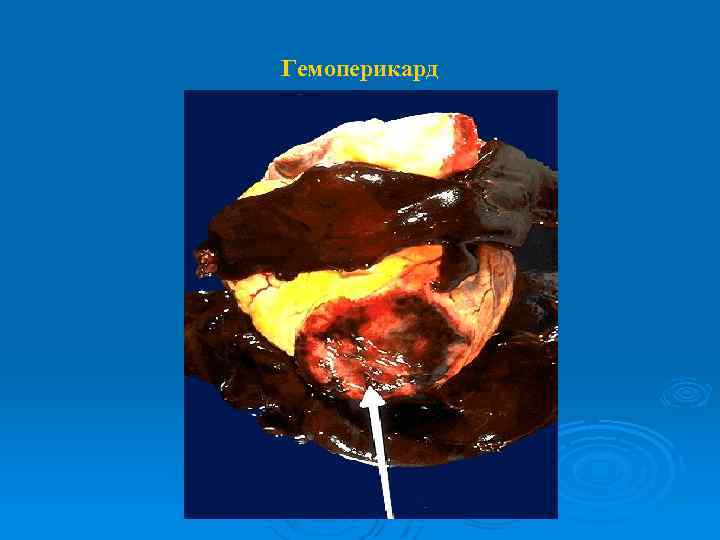 Гемоперикард 