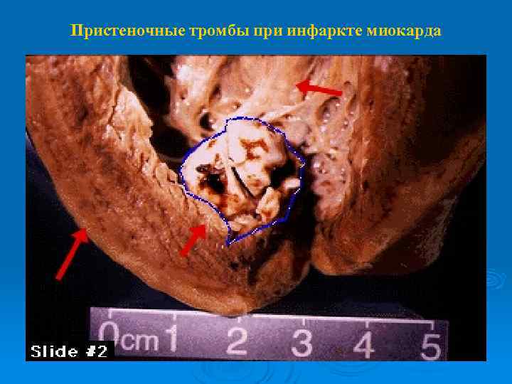 Пристеночные тромбы при инфаркте миокарда 