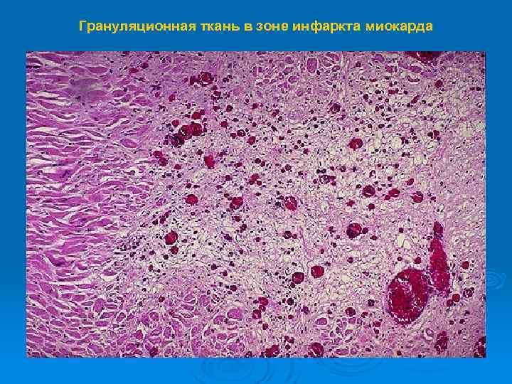 Грануляционная ткань в зоне инфаркта миокарда 