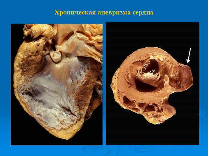 Хроническая аневризма сердца 