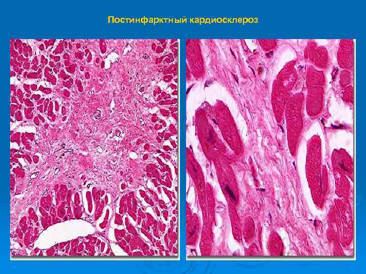 Постинфарктный кардиосклероз 