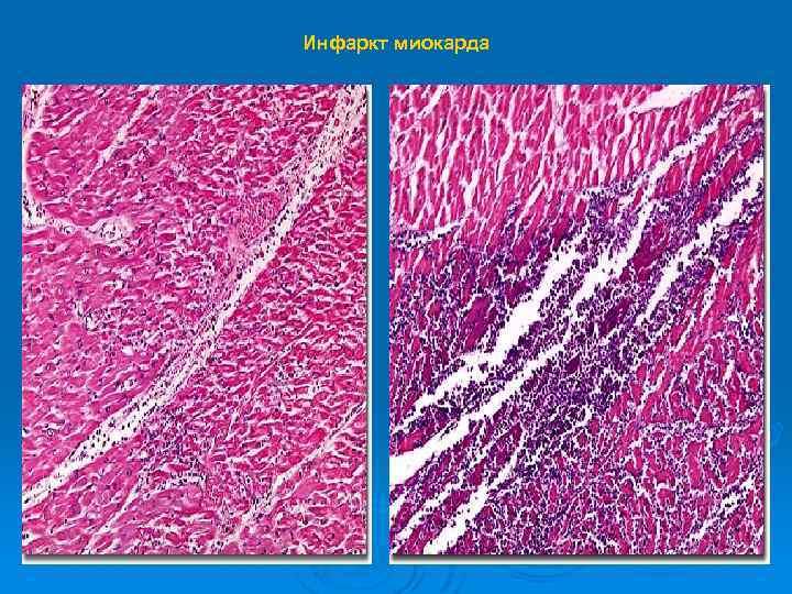 Инфаркт миокарда 