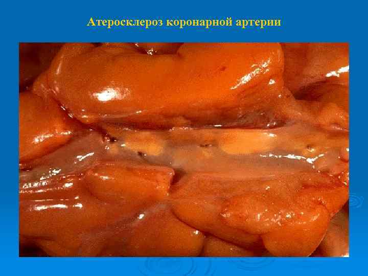 Атеросклероз коронарной артерии 