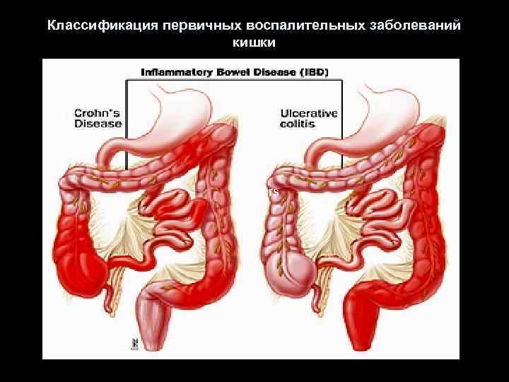 Классификация первичных воспалительных заболеваний кишки hampers 