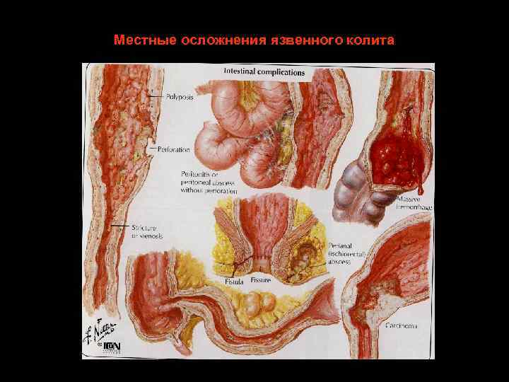 Местные осложнения язвенного колита 