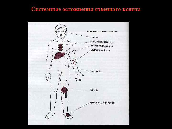 Системные осложнения язвенного колита 