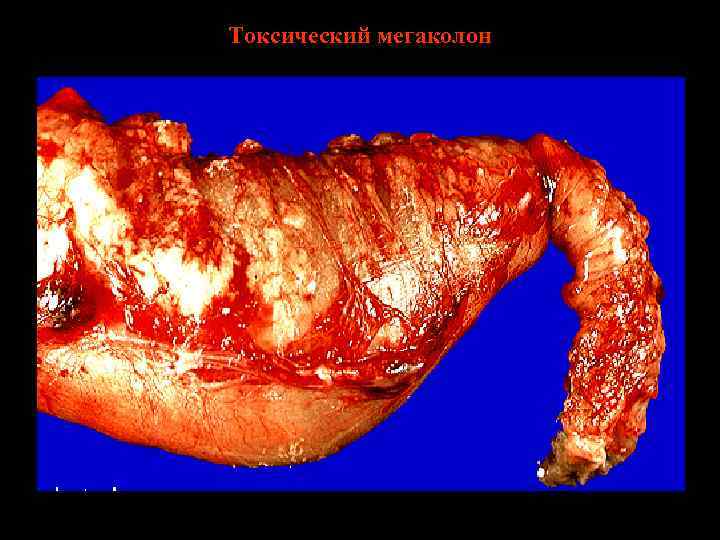 Токсический мегаколон 