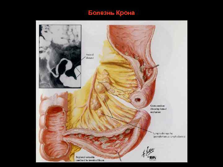 Болезнь Крона 