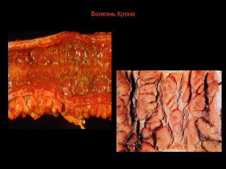 Болезнь Крона 