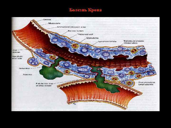 Болезнь Крона 