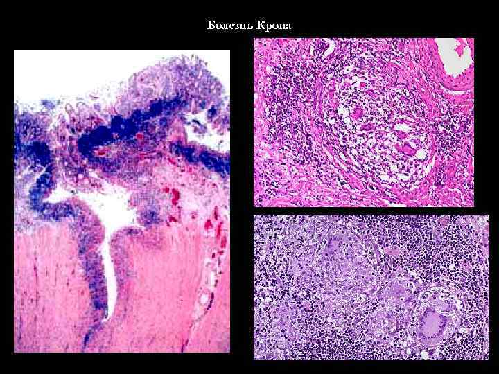 Болезнь Крона 