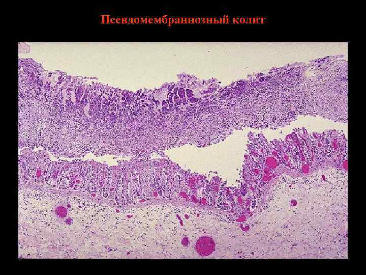 Псевдомембраннозный колит 