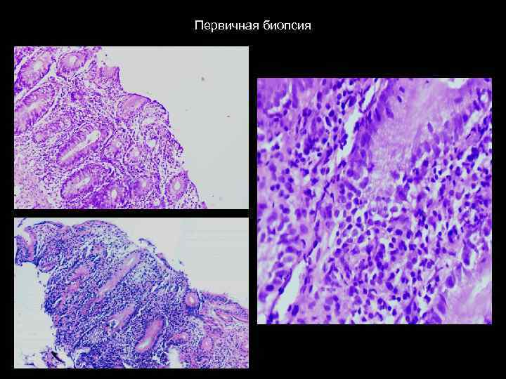 Первичная биопсия 