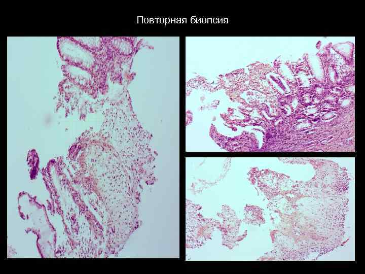 Повторная биопсия 