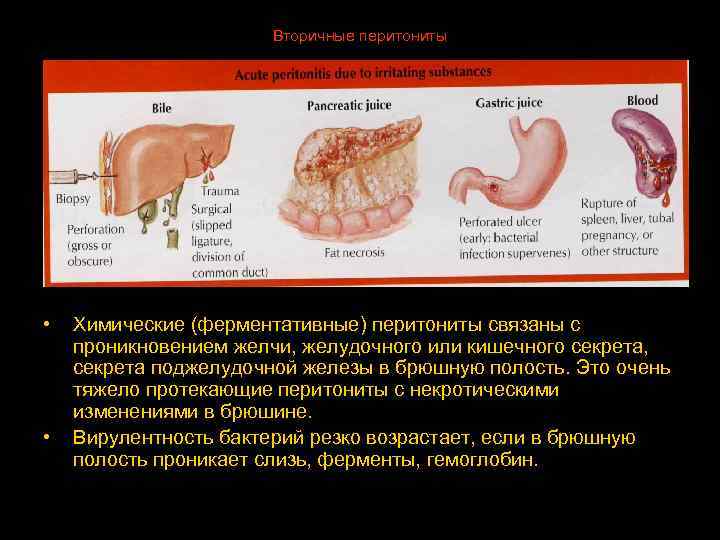 Вторичные перитониты • • Химические (ферментативные) перитониты связаны с проникновением желчи, желудочного или кишечного