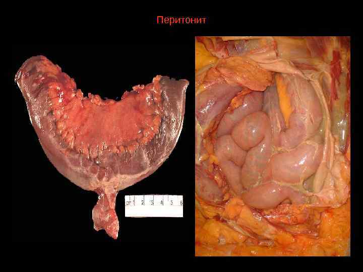 Перитонит 