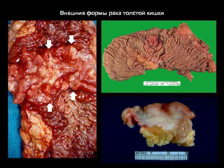 Внешние формы рака толстой кишки 