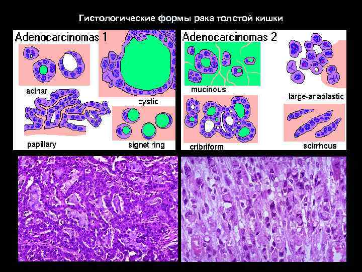 Гистологические формы рака толстой кишки 