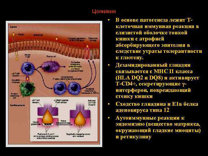 Целиакия • В основе патогенеза лежит Тклеточная иммунная реакция в слизистой оболочке тонкой кишки