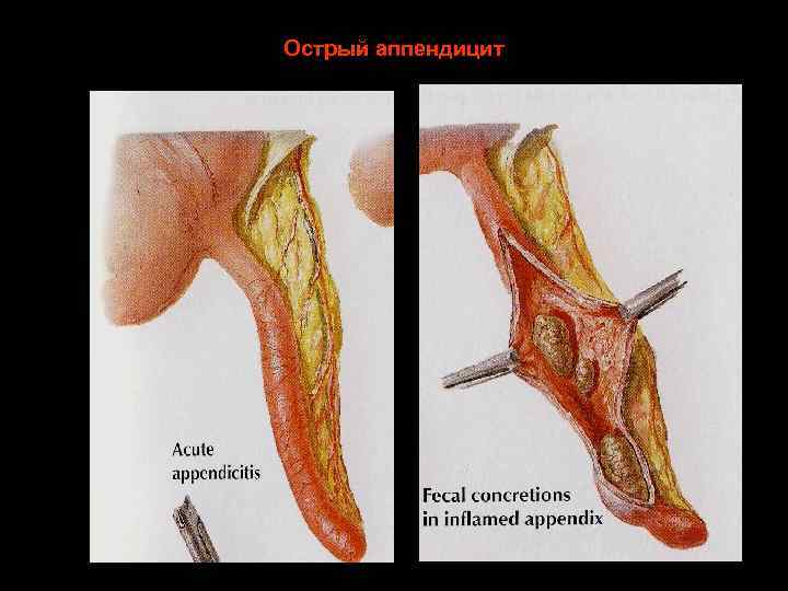 Острый аппендицит 