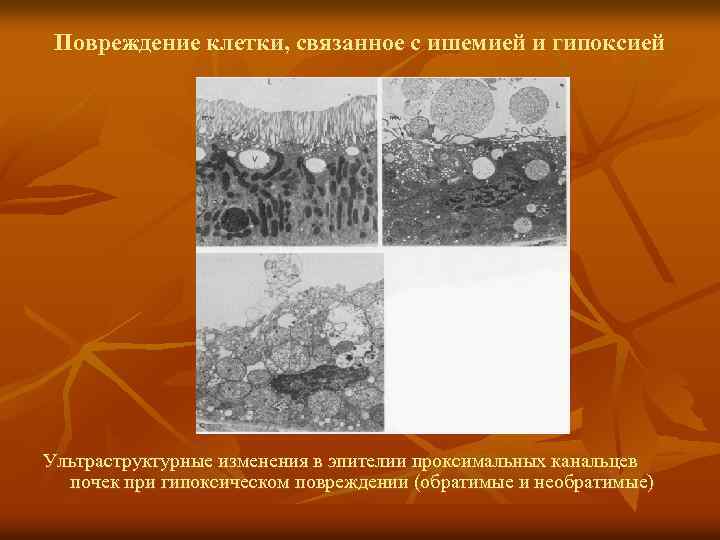 Повреждение клетки, связанное с ишемией и гипоксией Ультраструктурные изменения в эпителии проксимальных канальцев почек