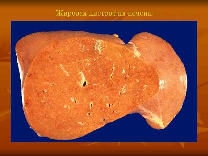 Жировая дистрофия печени 
