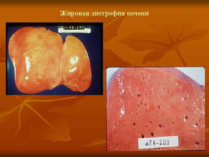 Жировая дистрофия печени 