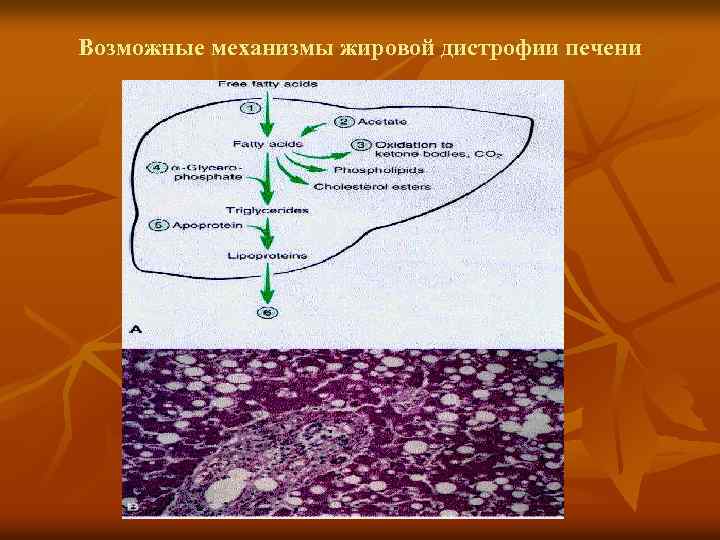 Возможные механизмы жировой дистрофии печени 