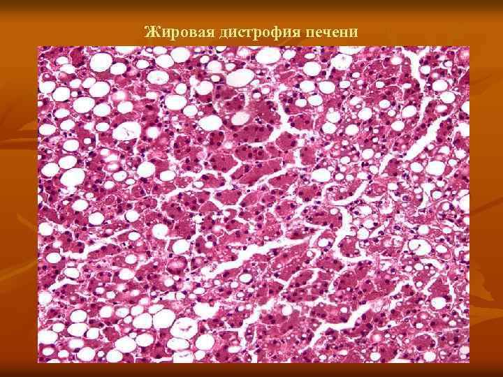 Жировая дистрофия печени 