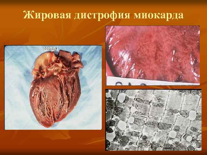 Жировая дистрофия миокарда 