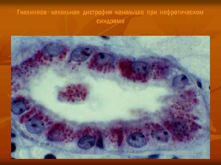 Гиалиново-капельная дистрофия канальцев при нефротическом синдроме 