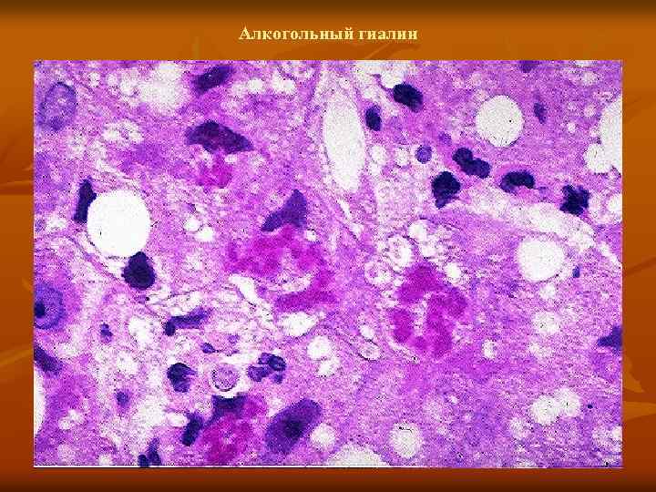 Алкогольный гиалин 