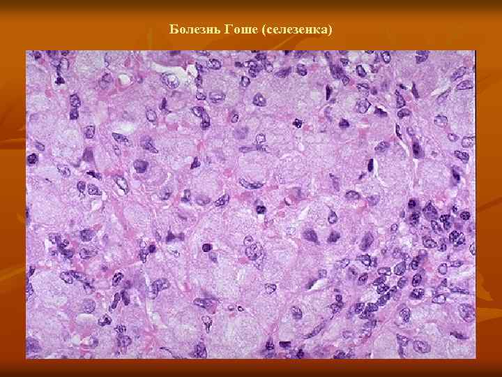 Болезнь Гоше (селезенка) 