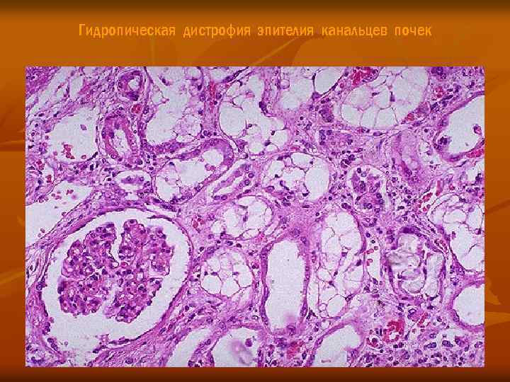 Гидропическая дистрофия эпителия канальцев почек 