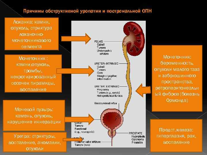 Причины обструктивной уропатии и постренальной ОПН Лоханка: камни, опухоль, стриктура лоханочномочеточникового сегмента Мочеточник :