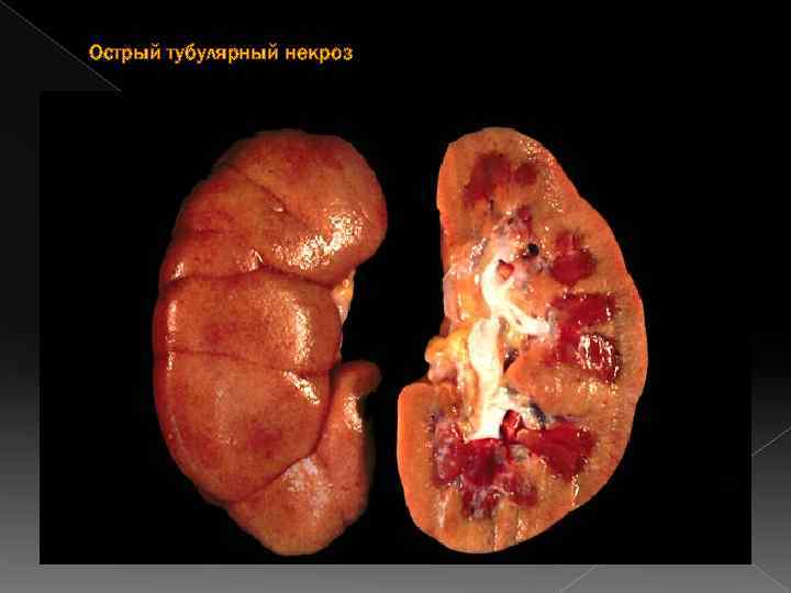Острый тубулярный некроз 