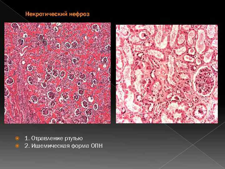 Некротический нефроз 1. Отравление ртутью 2. Ишемическая форма ОПН 
