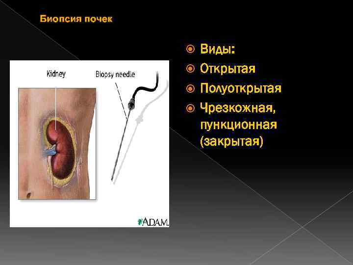 Биопсия почек Виды: Открытая Полуоткрытая Чрезкожная, пункционная (закрытая) 