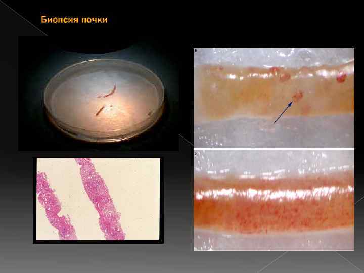 Биопсия почки 