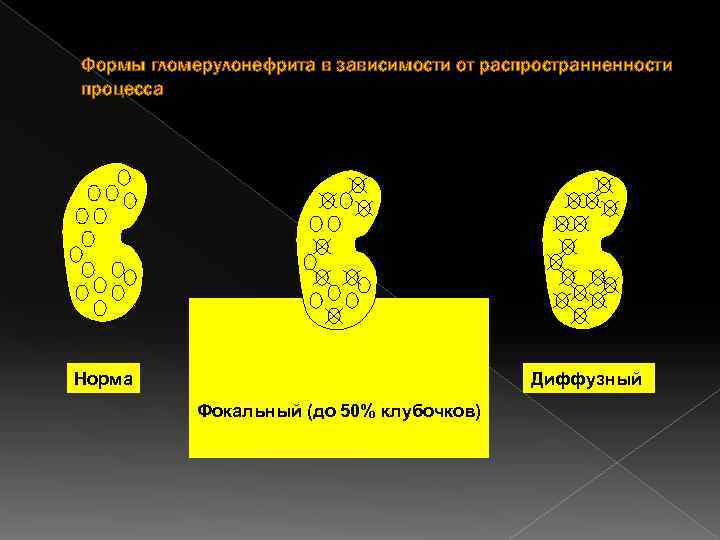 Формы гломерулонефрита в зависимости от распространненности процесса Норма Диффузный Фокальный (до 50% клубочков) 