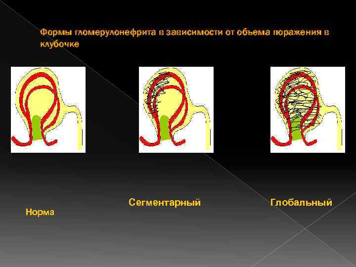 Формы гломерулонефрита в зависимости от объема поражения в клубочке Норма Сегментарный Глобальный 