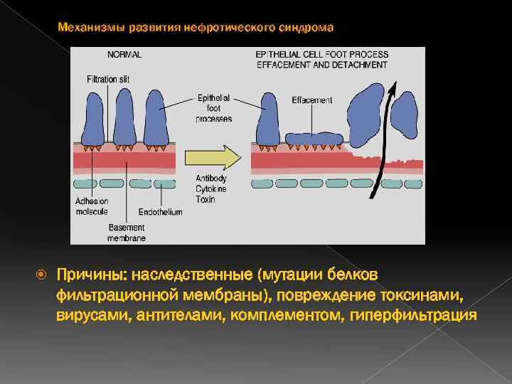 Механизмы развития нефротического синдрома Причины: наследственные (мутации белков фильтрационной мембраны), повреждение токсинами, вирусами, антителами,