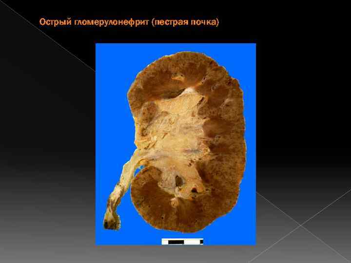 Острый гломерулонефрит (пестрая почка) 