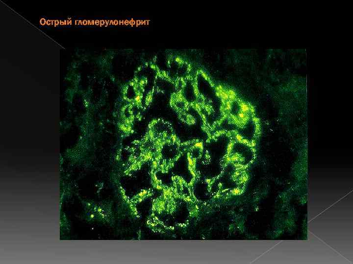 Острый гломерулонефрит 