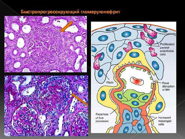 Гломерулонефрит патанатомия презентация