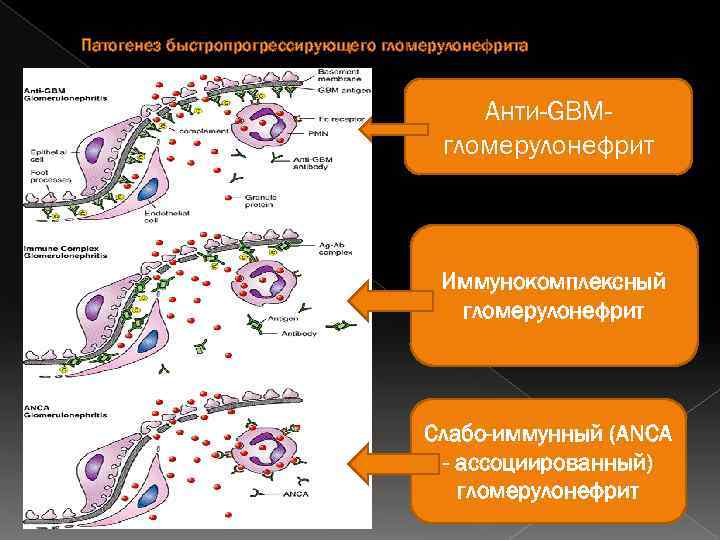 Схема иммунокомплексного повреждения клубочков