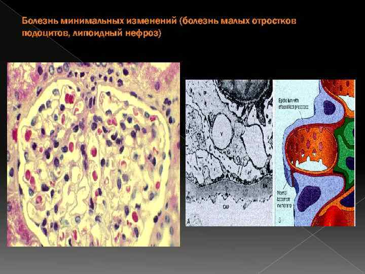Болезнь минимальных изменений (болезнь малых отростков подоцитов, липоидный нефроз) 